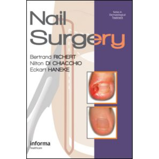 Nail Surgery Nail Surgery
