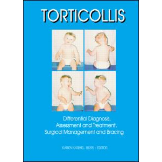 Torticollis Torticollis