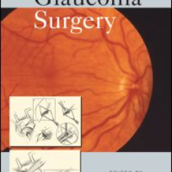 Glaucoma Surgery