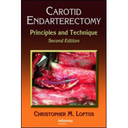 Carotid Endarterectomy