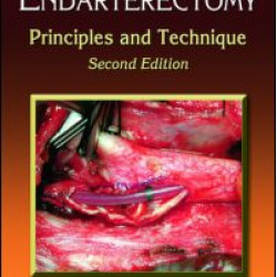 Carotid Endarterectomy Carotid Endarterectomy