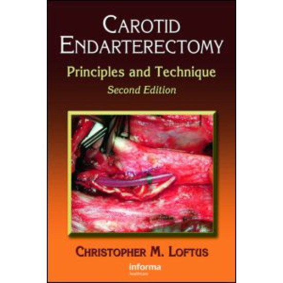 Carotid Endarterectomy Carotid Endarterectomy