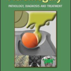 Acromegaly Acromegaly