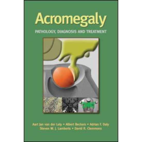 Acromegaly