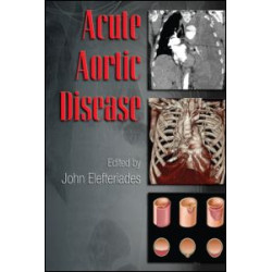 Acute Aortic Disease