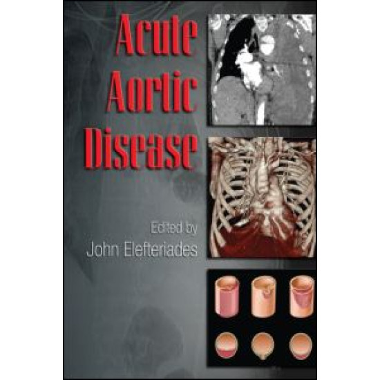 Acute Aortic Disease Acute Aortic Disease