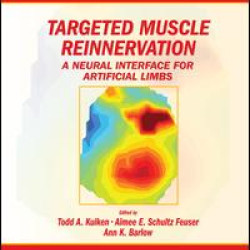 Targeted Muscle Reinnervation Targeted Muscle Reinnervation