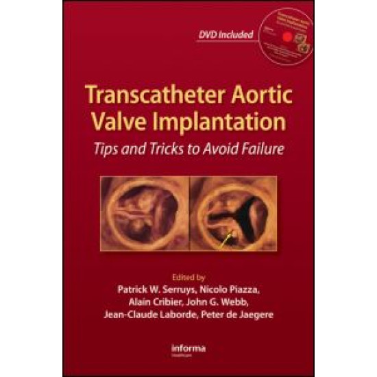 Transcatheter Aortic Valve Implantation Transcatheter Aortic Valve Implantation