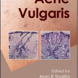 Acne Vulgaris Acne Vulgaris
