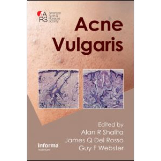 Acne Vulgaris