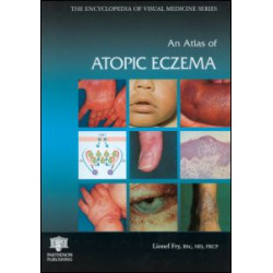 An Atlas of Atopic Eczema An Atlas of Atopic Eczema