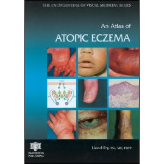 An Atlas of Atopic Eczema An Atlas of Atopic Eczema