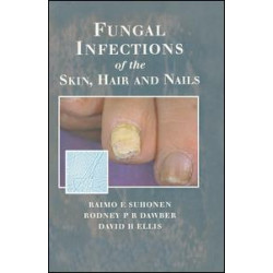 Fungal Infections of the Skin and Nails Fungal Infections of the Skin and Nails