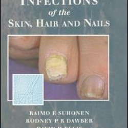 Fungal Infections of the Skin and Nails